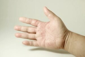 severely dry cracked hands