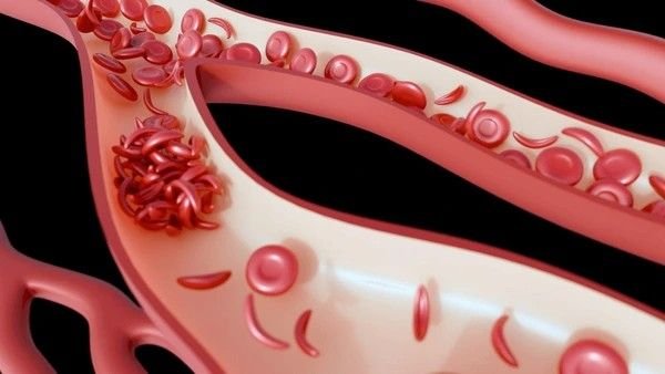 sickle cell pain