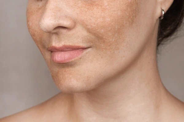 skin pigmentation