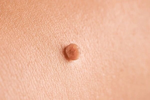 skin tags