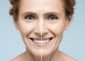 skin tightening