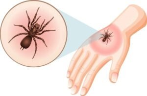 spider bites