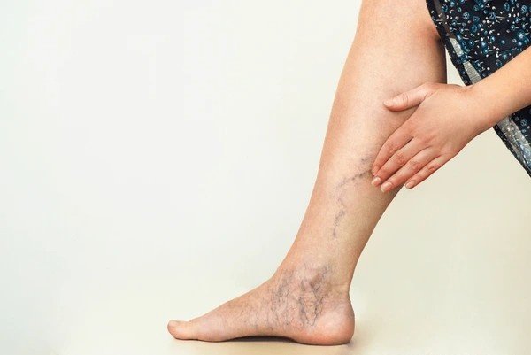 spider veins