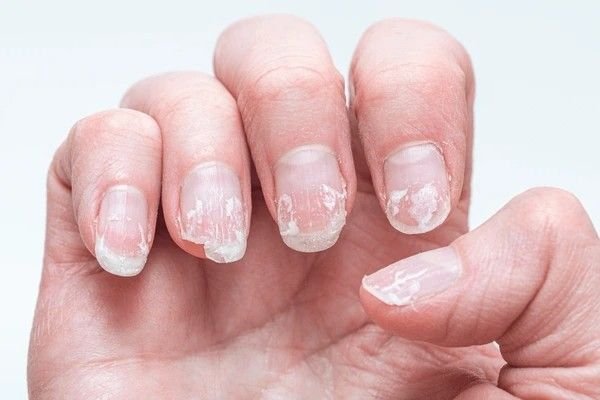 split nails