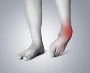 sprained ankle