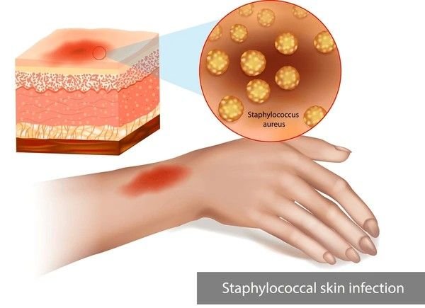 staph infection