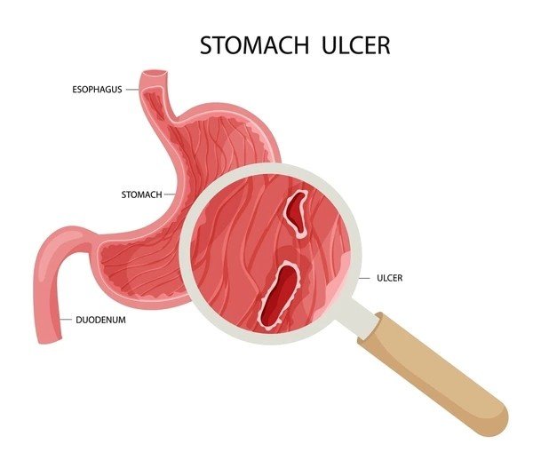 stomach ulcers