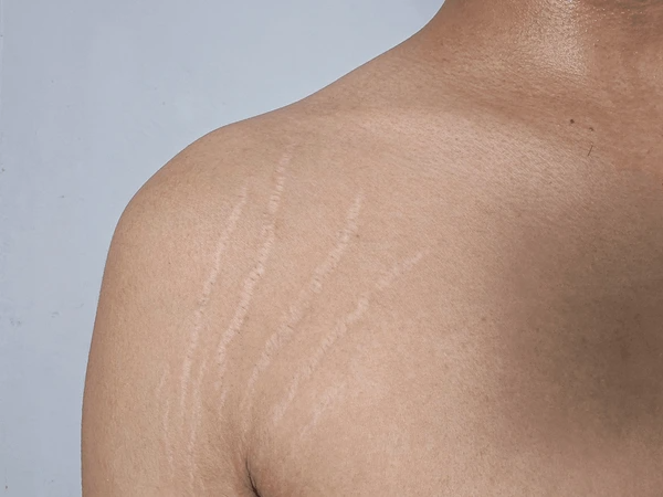 stretch marks