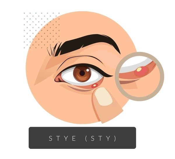 stye