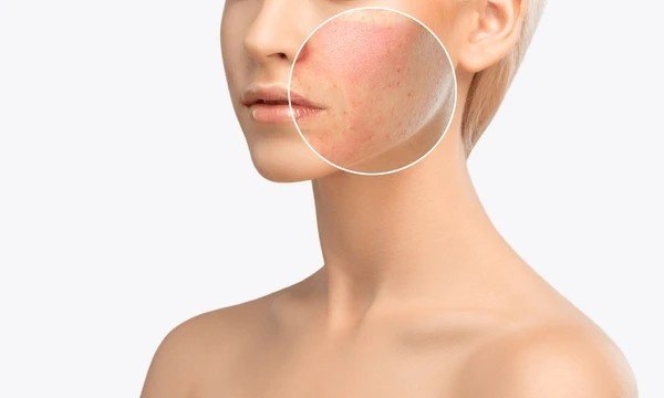 tan removal