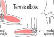 tennis elbow