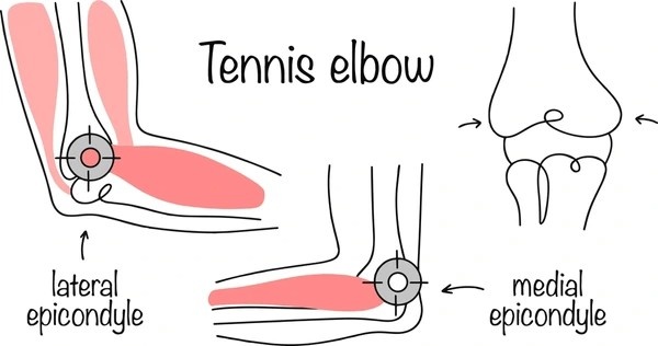 tennis elbow