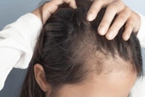 thinning hair