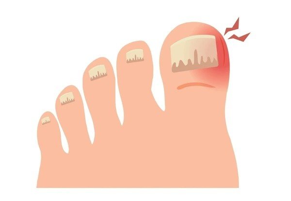 toenail fungus