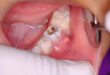 tooth infection