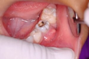 tooth infection