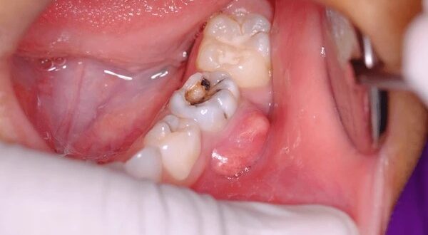 tooth infection