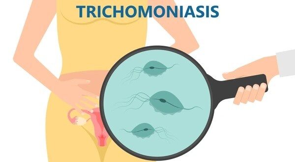 trichomoniasis