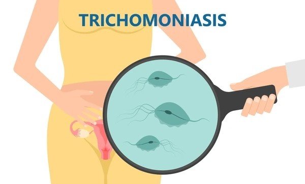 trichomoniasis