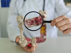 ulcerative colitis