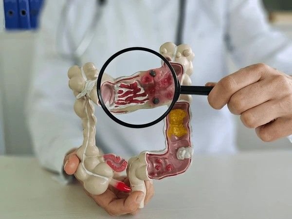 ulcerative colitis