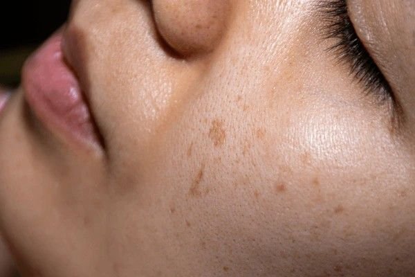 uneven skin tone on face