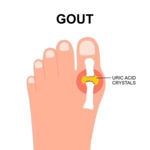 uric acid