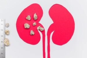 uric acid stones