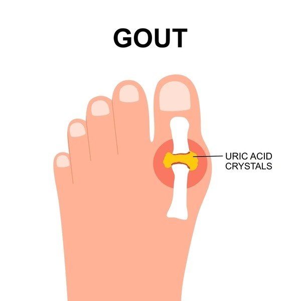 uric acid