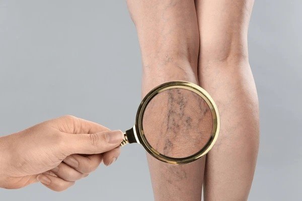 varicose veins