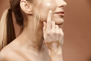 vitiligo