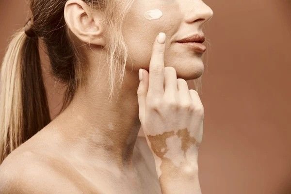 vitiligo