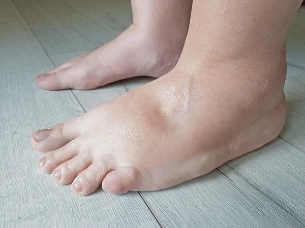 water retention