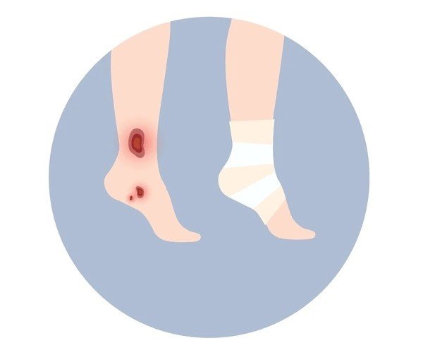 wounds on legs