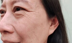 wrinkles and sagging skin