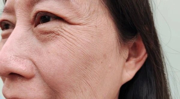 wrinkles and sagging skin