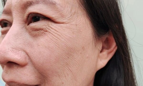 wrinkles and sagging skin